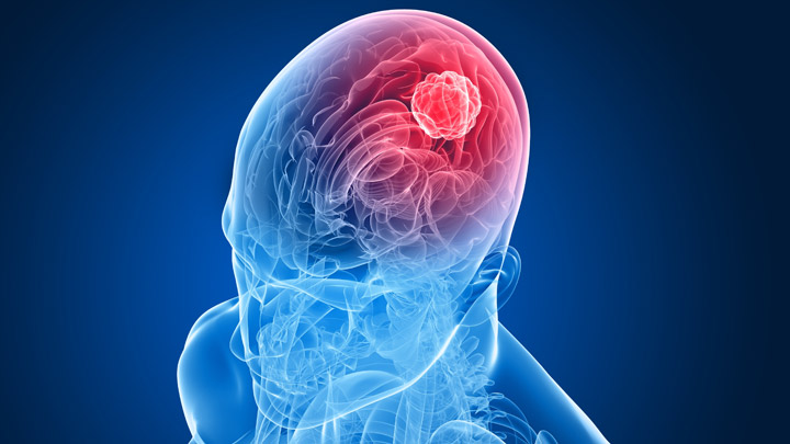 Brain Tumor Resection in Wichita
