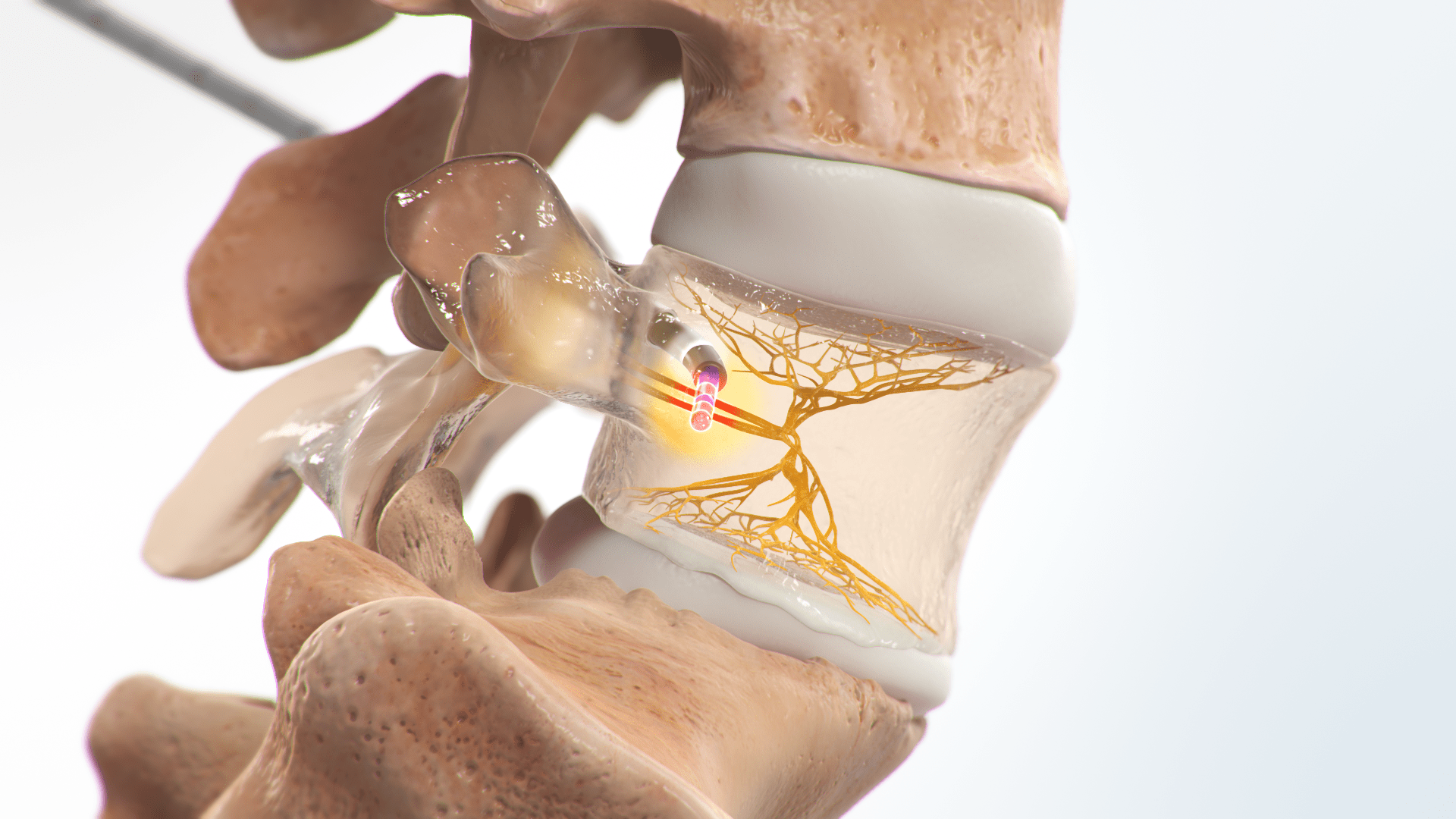 Up close image of Intracept procedure