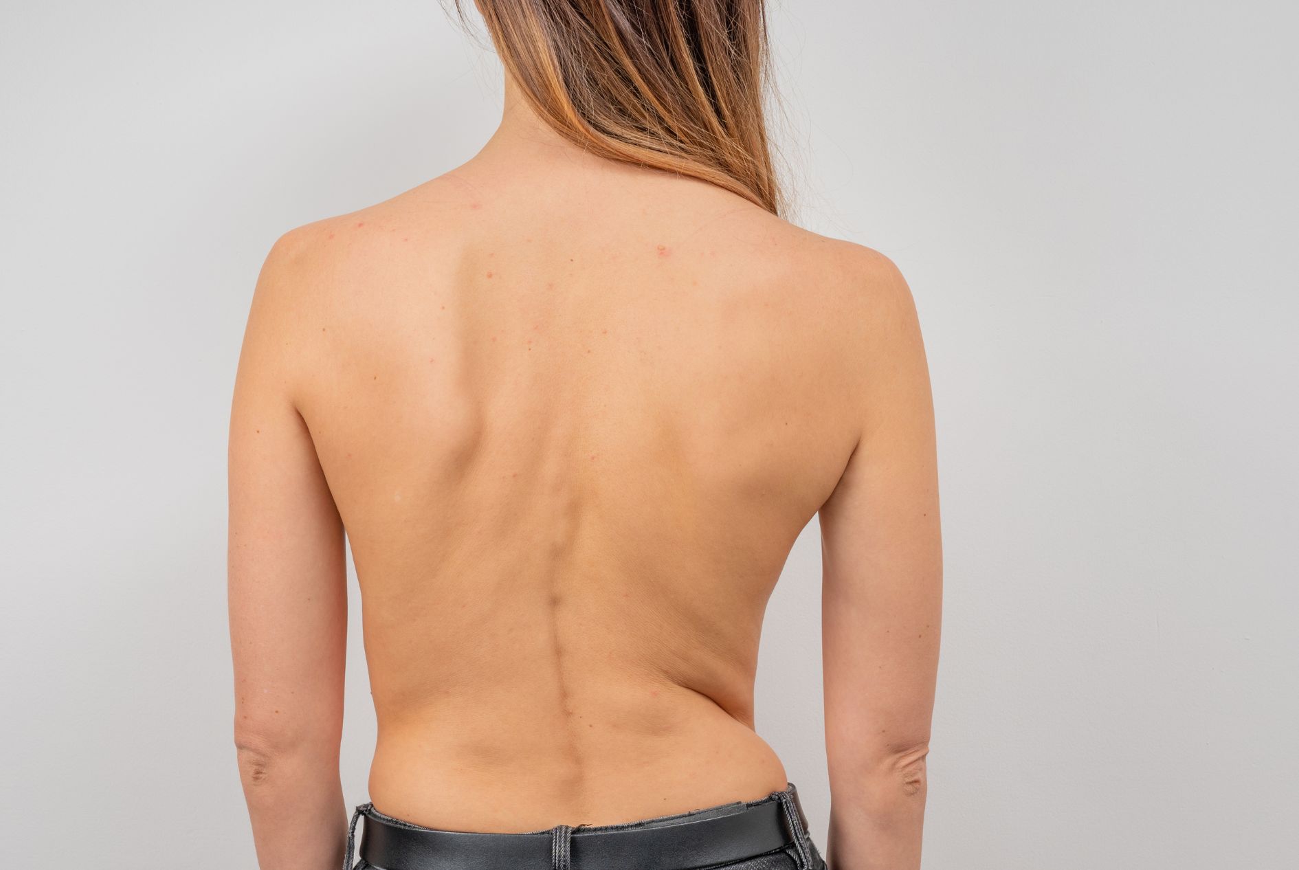 A young woman dealing with scoliosis.